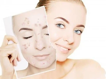 Izotretinoin és tretinoin, melyik a jobb?